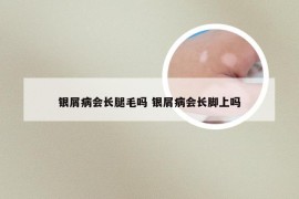 银屑病会长腿毛吗 银屑病会长脚上吗