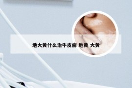 地大黄什么治牛皮癣 地黄 大黄