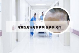 家用光疗治疗皮肤病 皮肤病 光疗