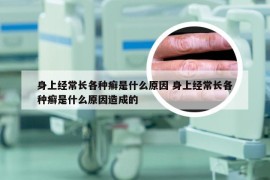 身上经常长各种癣是什么原因 身上经常长各种癣是什么原因造成的