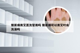 银屑病用艾蒿洗管用吗 银屑病可以用艾叶水洗澡吗
