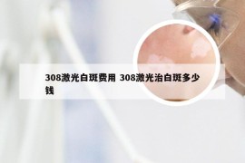 308激光白斑费用 308激光治白斑多少钱