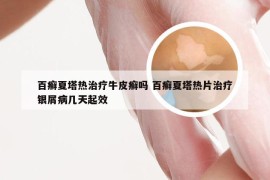 百癣夏塔热治疗牛皮癣吗 百癣夏塔热片治疗银屑病几天起效
