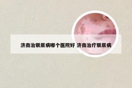 济南治银屑病哪个医院好 济南治疗银屑病