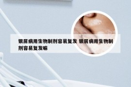 银屑病用生物制剂容易复发 银屑病用生物制剂容易复发嘛