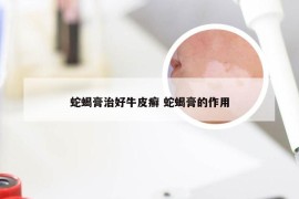 蛇蝎膏治好牛皮癣 蛇蝎膏的作用
