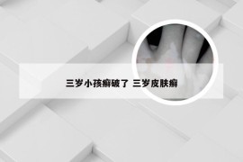 三岁小孩癣破了 三岁皮肤癣