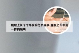 屁股上长了个牛皮癣怎么回事 屁股上长牛皮一样的硬块