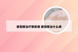 藤梨根治疗银屑病 藤梨根治什么病
