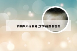 白癜风不治会自己好吗这里有答案