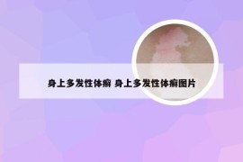 身上多发性体癣 身上多发性体癣图片