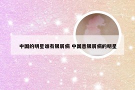 中国的明星谁有银屑病 中国患银屑病的明星