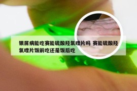 银屑病能吃赛能硫酸羟氯喹片吗 赛能硫酸羟氯喹片饭前吃还是饭后吃