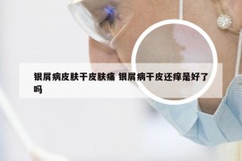 银屑病皮肤干皮肤痛 银屑病干皮还痒是好了吗