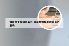 银屑病干痒痛怎么办 银屑病痒痒的厉害是严重吗
