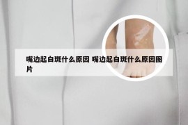 嘴边起白斑什么原因 嘴边起白斑什么原因图片