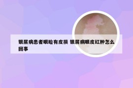银屑病患者眼睑有皮损 银屑病眼皮红肿怎么回事