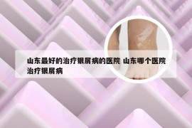 山东最好的治疗银屑病的医院 山东哪个医院治疗银屑病