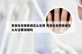 男朋友有银屑病怎么处理 男朋友有银屑病怎么办还要结婚吗