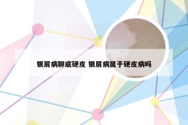 银屑病聊底硬皮 银屑病属于硬皮病吗