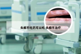 头癣不吃药可以吗 头癣不治疗