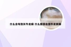 什么会导致长牛皮癣 什么原因会得牛皮肤癣