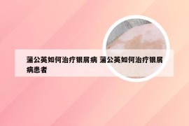 蒲公英如何治疗银屑病 蒲公英如何治疗银屑病患者