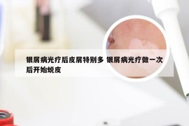 银屑病光疗后皮屑特别多 银屑病光疗做一次后开始蜕皮
