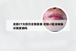 皮肤CT大致符合银屑病 皮肤ct能准确确诊银屑病吗