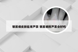 银屑病皮肤能用芦荟 银屑病擦芦荟会好吗