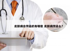 皮肤病会传染的有哪些 皮肤病传染么?