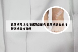 银屑病可以接打新冠疫苗吗 银屑病患者能打新冠病毒疫苗吗