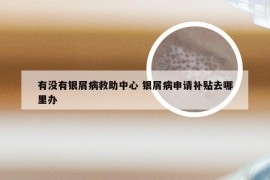 有没有银屑病救助中心 银屑病申请补贴去哪里办
