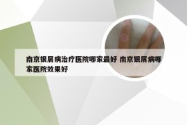 南京银屑病治疗医院哪家最好 南京银屑病哪家医院效果好