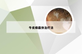牛皮癣最快治疗法