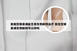 脓疱型银屑病能否用生物制剂治疗 脓包型银屑病生物制剂可以停吗