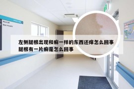 左侧腿根出现和癣一样的东西还痒怎么回事 腿根有一片癣是怎么回事