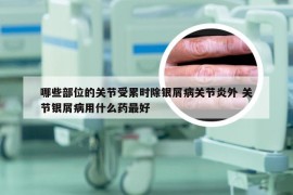哪些部位的关节受累时除银屑病关节炎外 关节银屑病用什么药最好