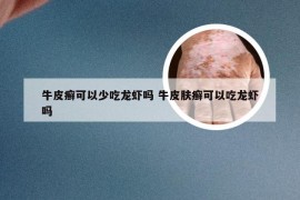 牛皮癣可以少吃龙虾吗 牛皮肤癣可以吃龙虾吗