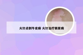 火针点刺牛皮癣 火针治疗银屑病