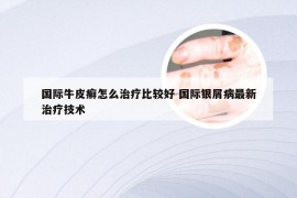 国际牛皮癣怎么治疗比较好 国际银屑病最新治疗技术