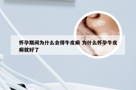 怀孕期间为什么会得牛皮癣 为什么怀孕牛皮癣就好了