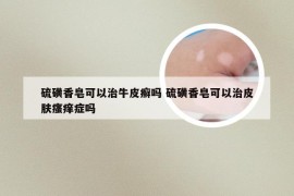硫磺香皂可以治牛皮癣吗 硫磺香皂可以治皮肤瘙痒症吗