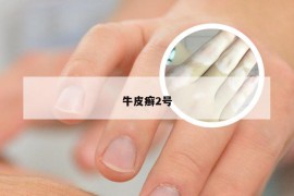 牛皮癣2号