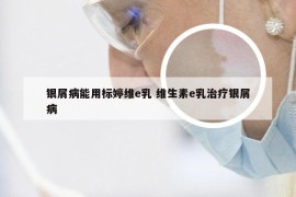银屑病能用标婷维e乳 维生素e乳治疗银屑病