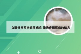 白醋外用可治银屑病吗 醋治疗银屑病的偏方