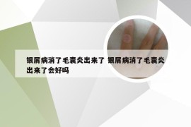 银屑病消了毛囊炎出来了 银屑病消了毛囊炎出来了会好吗