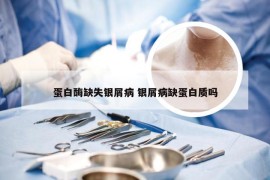 蛋白酶缺失银屑病 银屑病缺蛋白质吗
