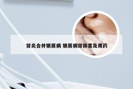 肾炎合并银屑病 银屑病肾损害及用药