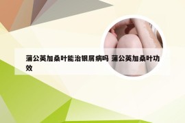 蒲公英加桑叶能治银屑病吗 蒲公英加桑叶功效